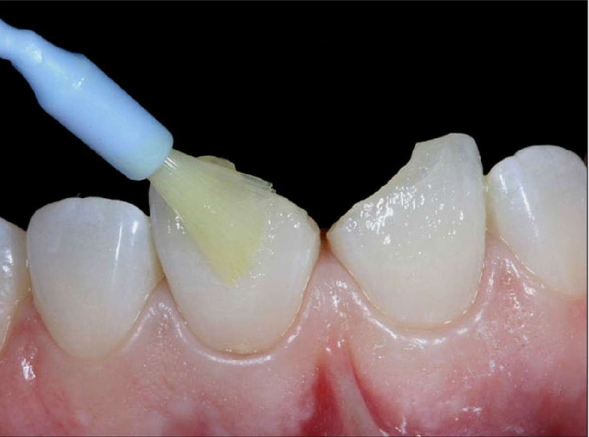 On-Demand Webinars: Refine Your Restorative Techniques