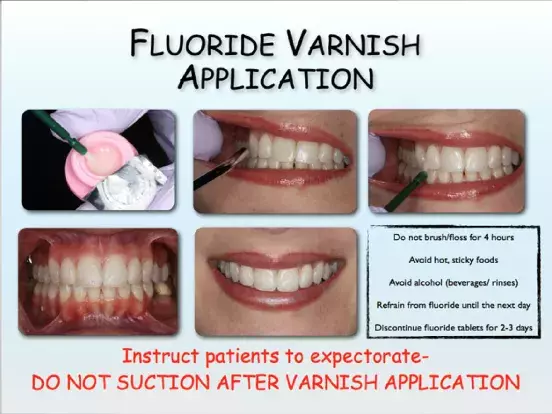 Using Fluoride Varnish for Improved Patient Outcomes