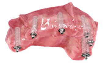 Implanty z dopasowanymi z łącznikami protetycznymi, służącymi jako filary dla mostu