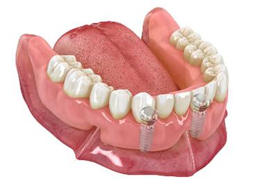 denture fitted