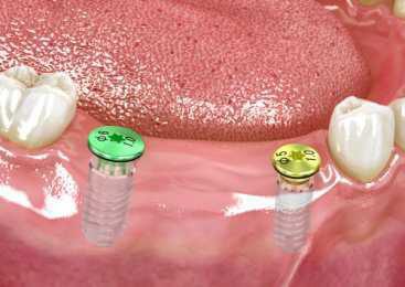 implants with cover screw