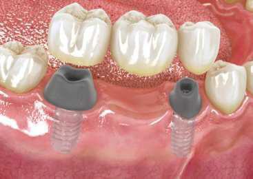 Auf dem Implantat befestigte künstliche Aufbauten (Abutments), Einprobe der Brücke