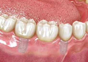 Zastępujący utracone zęby ceramiczny most zamocowany na implantach.