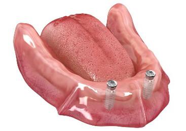 Edentulous jaw with 2 implants