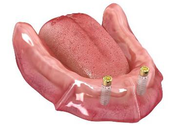 Mit Abutments versehene Implantate (in diesem Fall Locator ® Abutments)