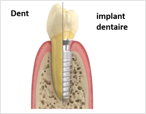 Comparaison dentaire - Implant dentaire