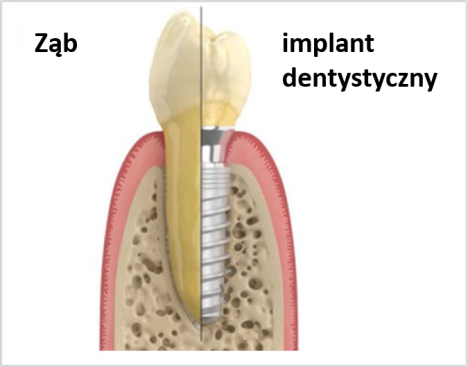 Porównanie Ząb - implant