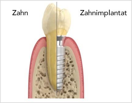 Vergleich Zahn - Zahnimplantat