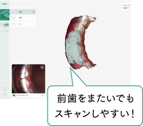 前歯をまたいでもスキャンしやすい!