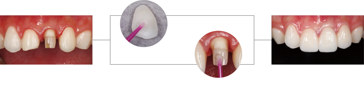 リチウムシリケートガラスセラミック