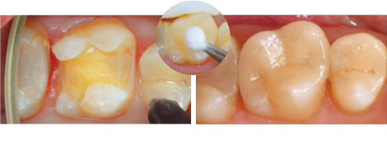 セラミック　インレー