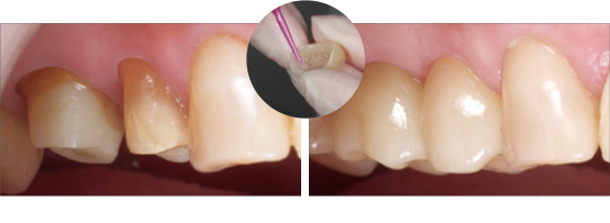ジルコニア　クラウン
