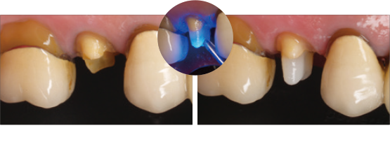 ファイバーポスト　コア