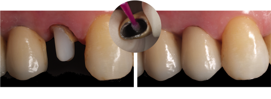 メタルセラミックス