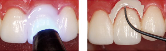 セメントの除去