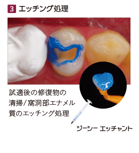 エッチング処理