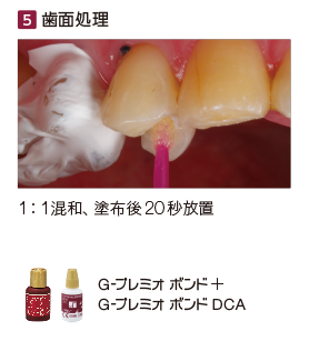 歯面処理