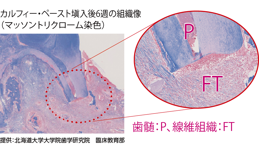 カルフィー・ペースト塡入後6週の組織像（マッソントリクローム染色）- 歯髄：P、線維組織：FT