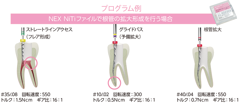 プログラム例 NEX NiTiファイルで根管の拡大形成を行う場合