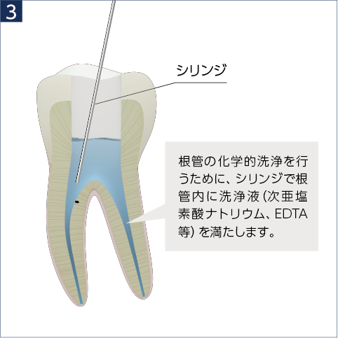 0°に曲げる場合 - レンチを上向きに装着して、照明用LEDの方向へ曲げる
