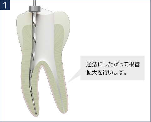 通法にしたがって根管拡大を行います。