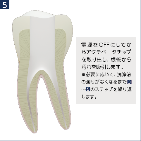 電源をOFFにしてからアクチベータチップを取り出し、根管から汚れを吸引します。※必要に応じて、洗浄液の濁りがなくなるまで3~5のステップを繰り返します。