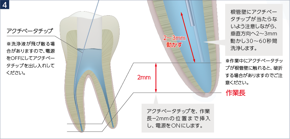 アクチベータチップ ※洗浄液が飛び散る場合がありますので、電源をOFFにしてアクチベータチップを出し入れしてください。アクチベータチップを、作業長-2mmの 位 置 まで挿入し、電源をONにします。根管壁にアクチベータチップが当たらないよう注意しながら、垂直方向へ2~3mm動かし30~60秒間洗浄します。※作業中にアクチベータチップが根管壁に触れると、破折する場合がありますのでご注意ください。