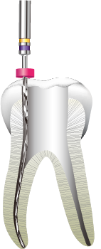 グライドパス(予備拡大)