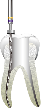 グライドパス（予備拡大）