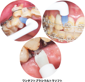 普通のブラシでは磨きにくいところも