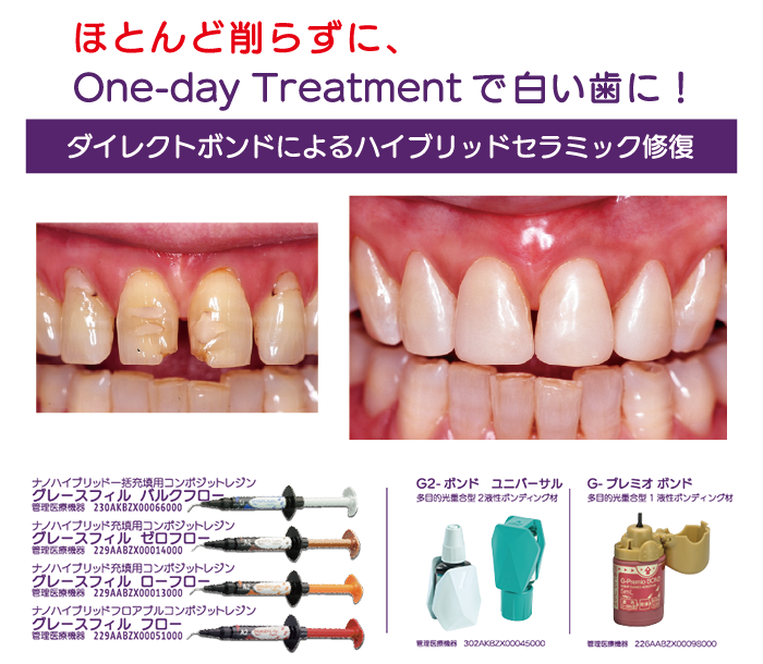 GC Web セミナー Playback ダイレクトボンディングのすゝめ