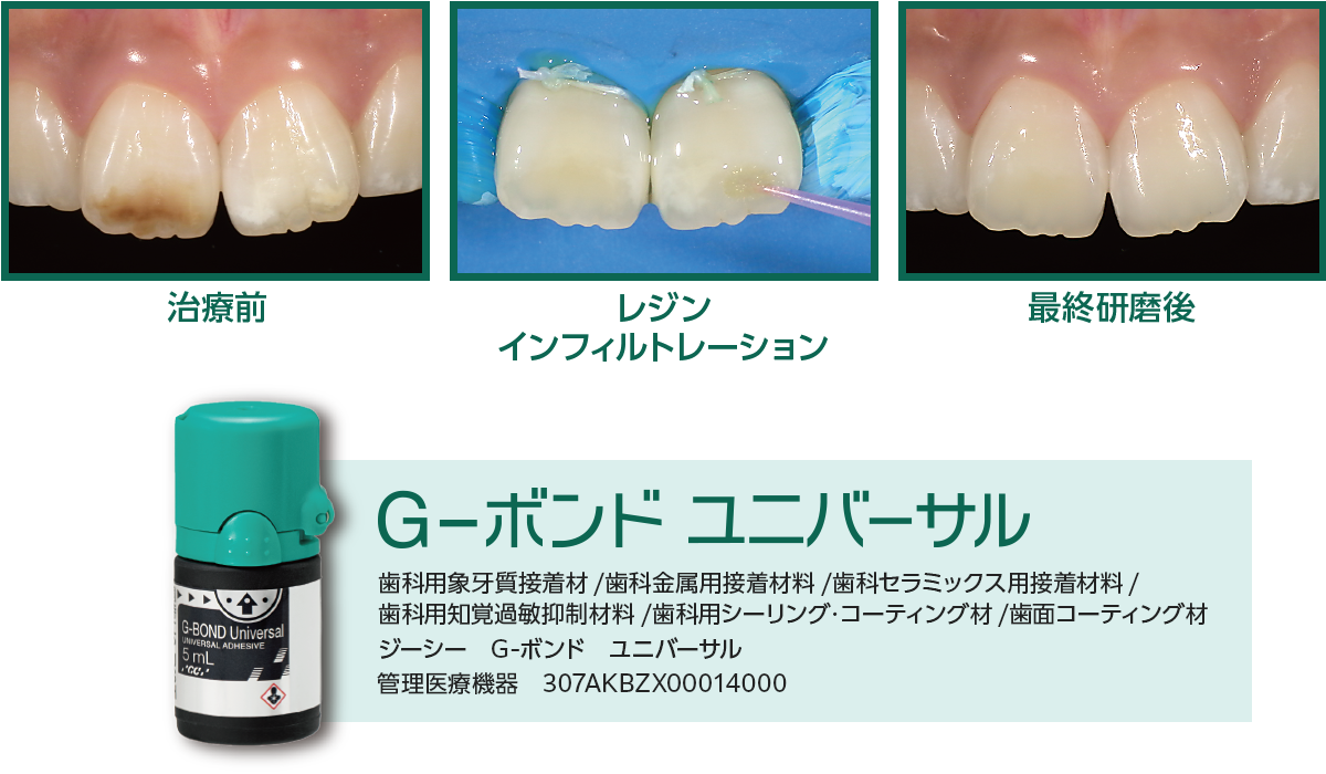 GC WebセミナーLIVE】ホワイトスポット・ブラウンスポット治療の次の一手