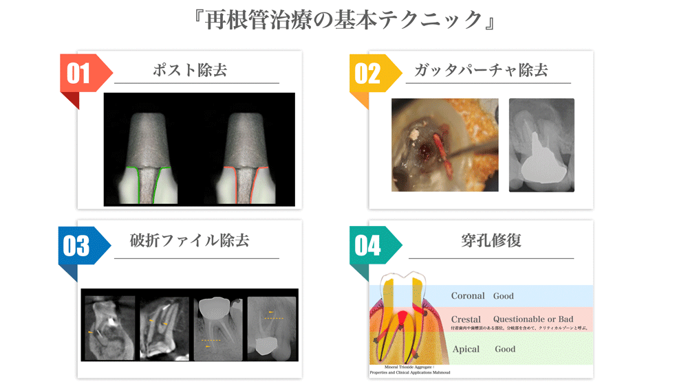 6/24～順次配信】歯内療法をトータルで学ぶ！無菌的処置から外科的歯内