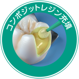 コンポジットレジン充填