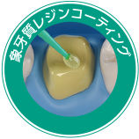 象牙質レジンコーティング