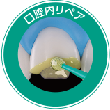 口腔内リペア