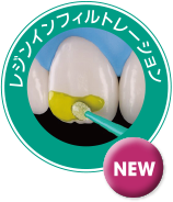 レジンインフィルトレーション