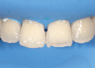 エタノールを30秒間作用させて乾燥し、審美的改善の見込みを確認(白濁が残存している場合はエッチング処理を追加で実施)