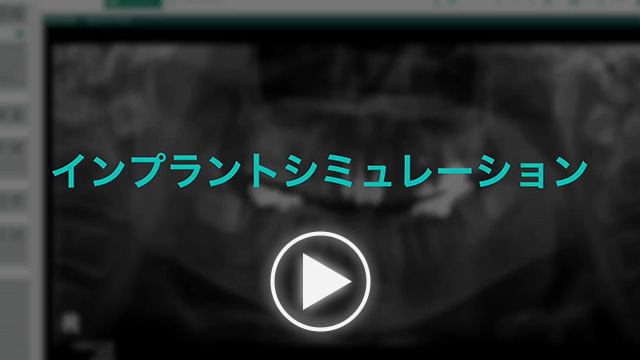 動画：Aadva Station／インプラントシミュレーションのサムネイル