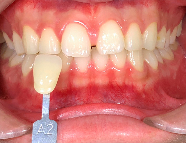 ホワイトニング後