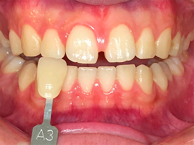 ホワイトニング前