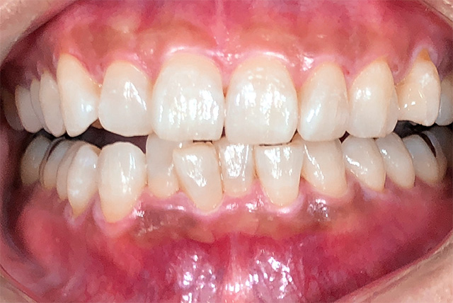 ホワイトニング後