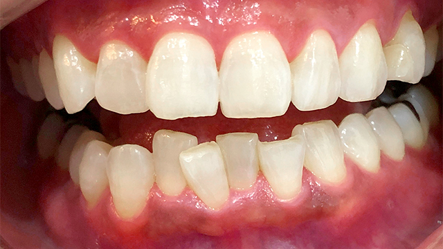 ホワイトニング後