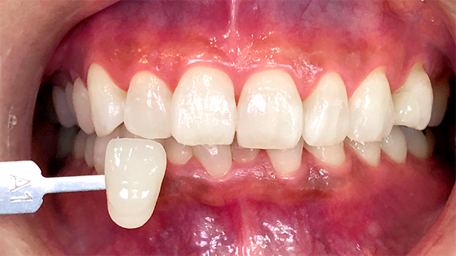 ホワイトニング後