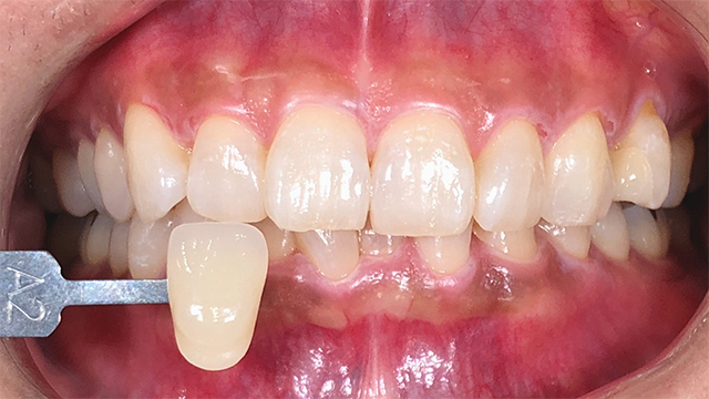 ホワイトニング後