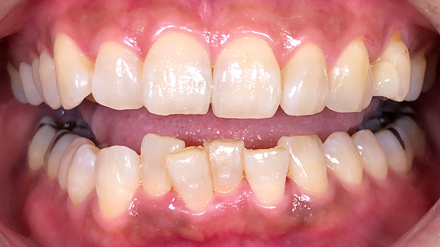 ホワイトニング前