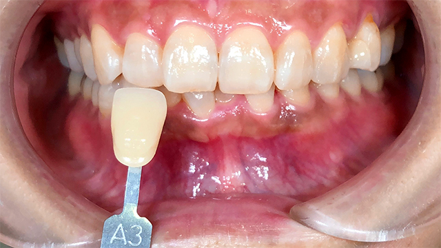 ホワイトニング前
