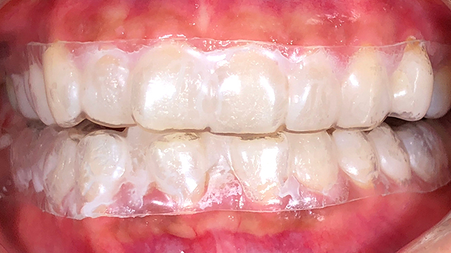 ホワイトニング中