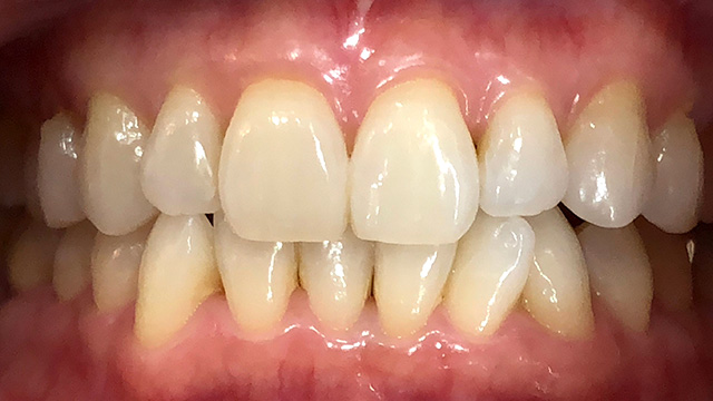 追加ホワイトニング後