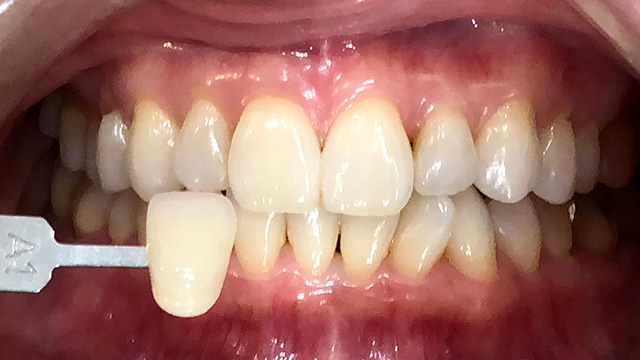 ホワイトニング後